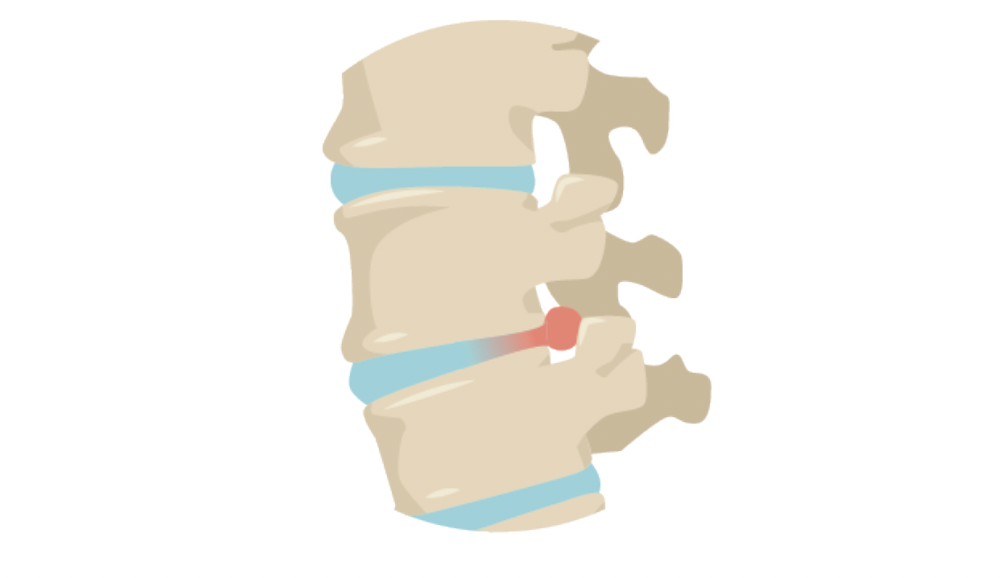 troubles musculo squelettiques